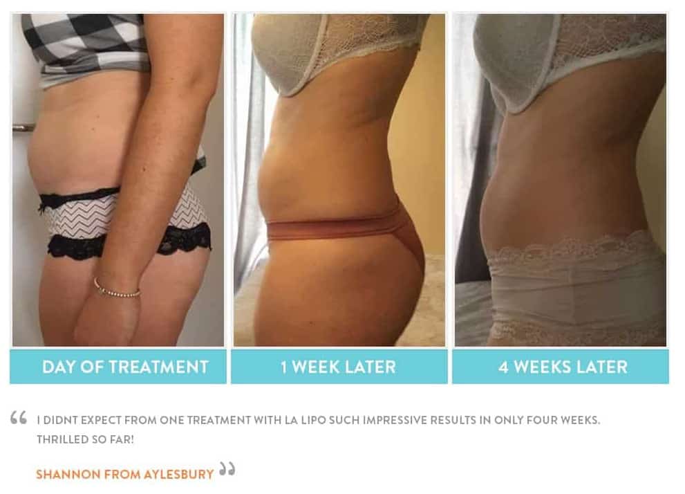 before, Cryolipolysis Old Trafford