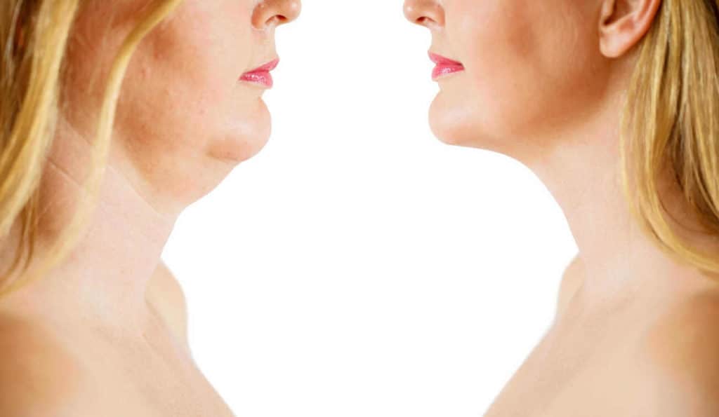 Double Chin treatment Old Trafford before and after results