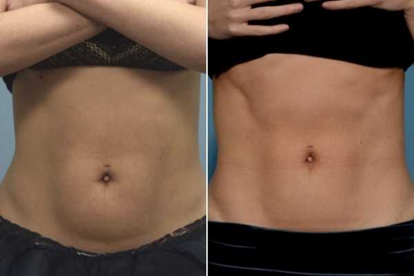 body sculpting FAQs Old Trafford