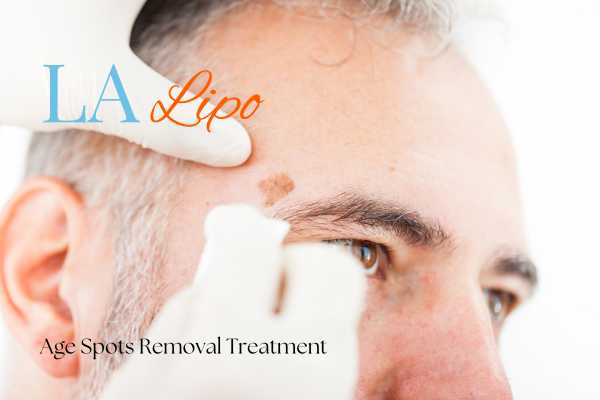 What Are the Most Effective Treatments for Age Spots Old Trafford?