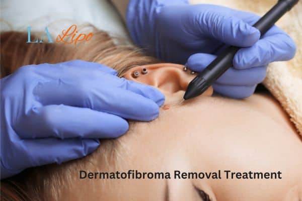 Dermatofibroma Removal Treatment Old Trafford
