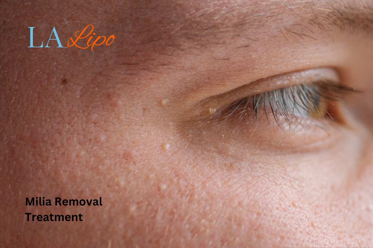 Cryopen Milia Removal: Is It the Easiest and Safest Option Old Trafford?