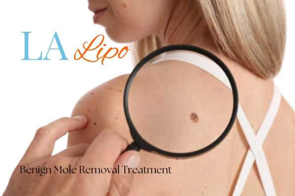 Why getting moles removed Old Trafford can boost your confidence!