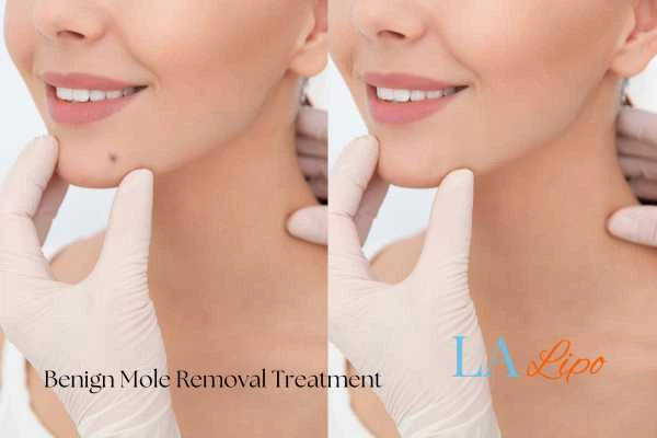 woman's before and after mole removal Old Trafford results