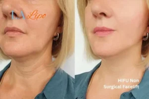 hi-fu for wrinkles Old Trafford before and after results
