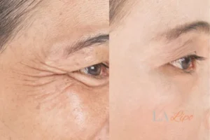 Before and after results of woman - HI-fu wrinkles reduction treatment Old Trafford