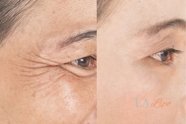 Before and after results of woman - HI-fu wrinkles reduction treatment Old Trafford
