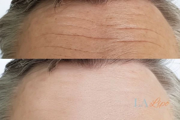 results of HIFU Old Trafford on mans forehead to help reduce lines and wrinkles