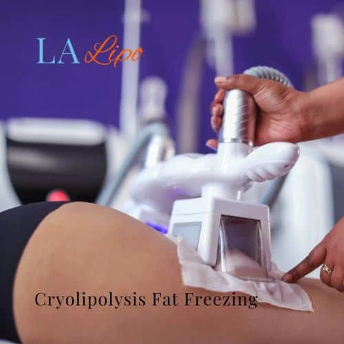 fat freezing - Cryolipolysis Old Trafford