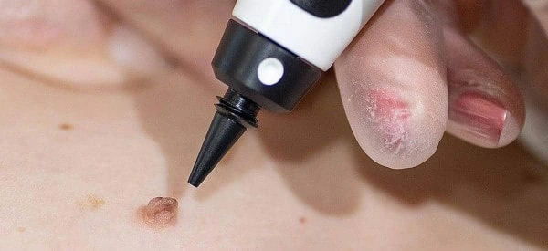 skin tag removal using cryopen Old Trafford