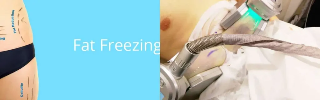 Fat freezing Old Trafford on multiple areas of the body