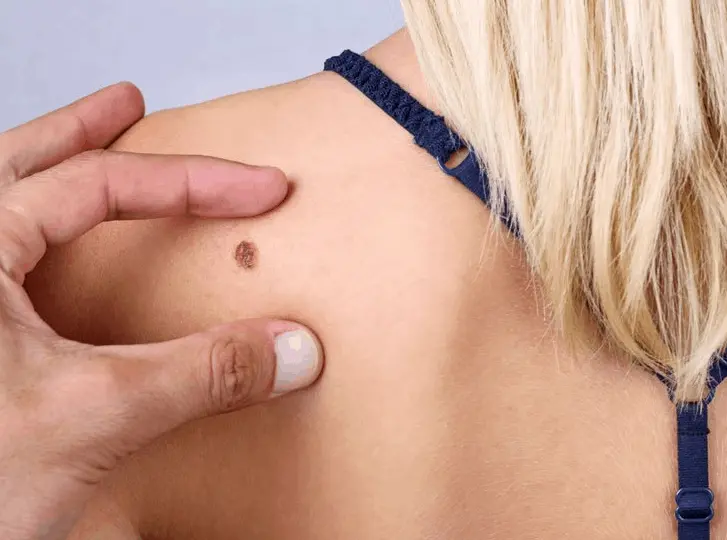 woman having mole removal Old Trafford consultation before treatment.