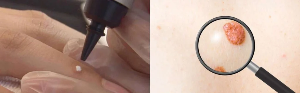 Person getting moles removed with cryopen Old Trafford