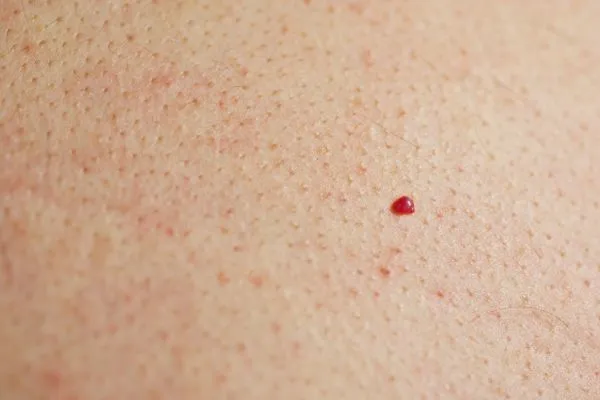 close up of a cherry angioma Old Trafford