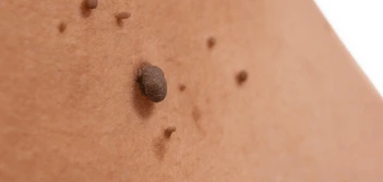 image of a skin tag Old Trafford
