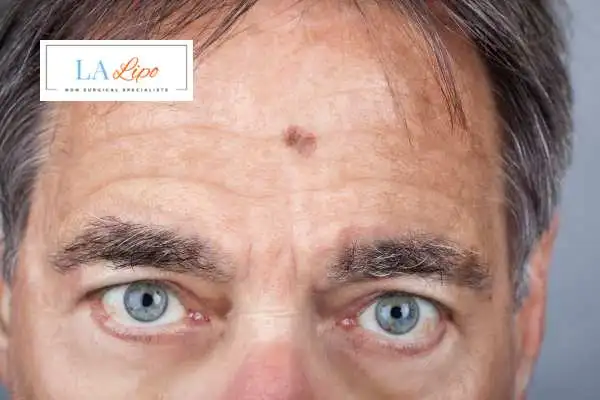 Solar Lentigo Removal Old Trafford image of man with mark on his forehead