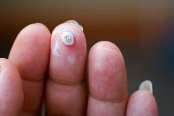 wart on person finger - cryotherapy to treat from LA LIPO Old Trafford