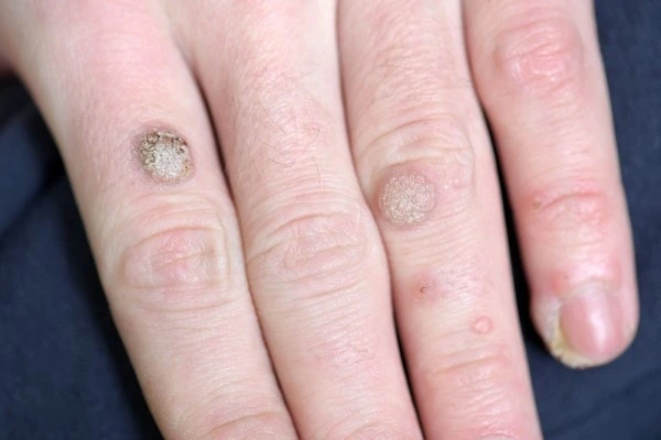 photo of warts on person hand - see wart removal Old Trafford from LA LIPO