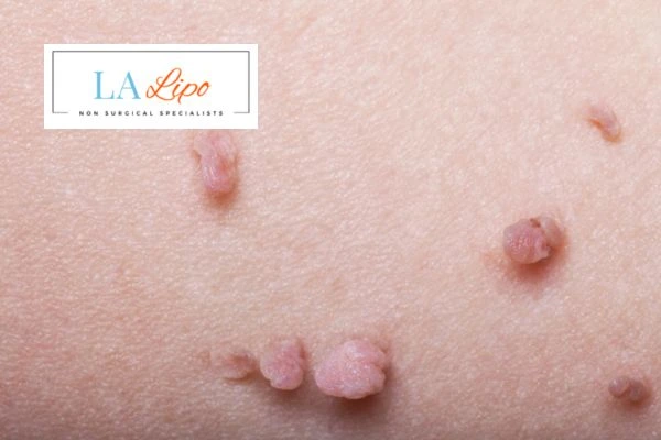 Does cryopen skin tag removal Old Trafford hurt? Find out now call our team today!