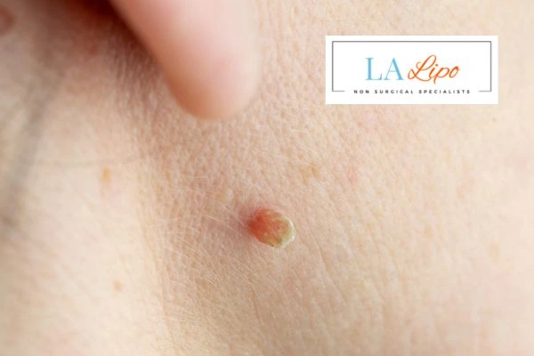 Book skin tag removal Old Trafford today speak to our team now!