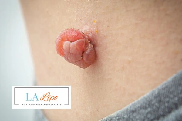 Interested in skin tag removal Old Trafford? Concerned about the pain? Find out more today!