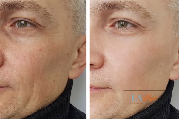 See the amazing results of Morpheus8 Treatment Old Trafford!