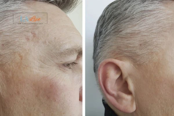 Mens Before & After Morpheus 8 Results Old Trafford