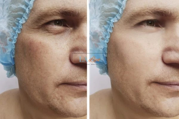 Before and after Morpheus 8 Results Old Trafford