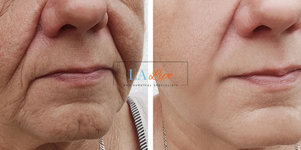 Older lady deeper wrinkle reduction - LA LIPO Morpheus 8 Results Old Trafford