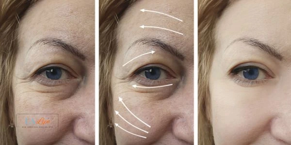 Amazing eye lift Morpheus 8 results Old Trafford