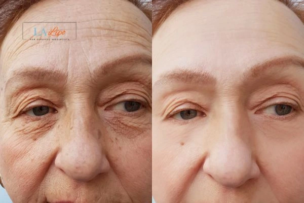 The powerful benefits of Morpheus8 Treatment Old Trafford - Call Our team today!