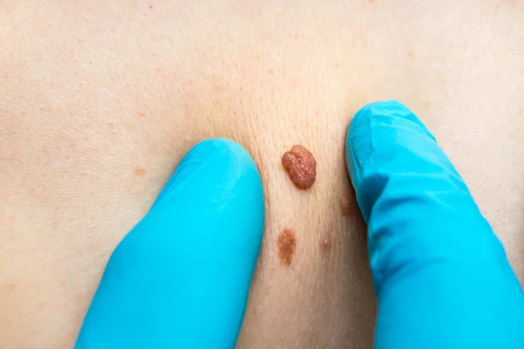 LA LIPO Cryopen Lesion Removal Prices Old Trafford