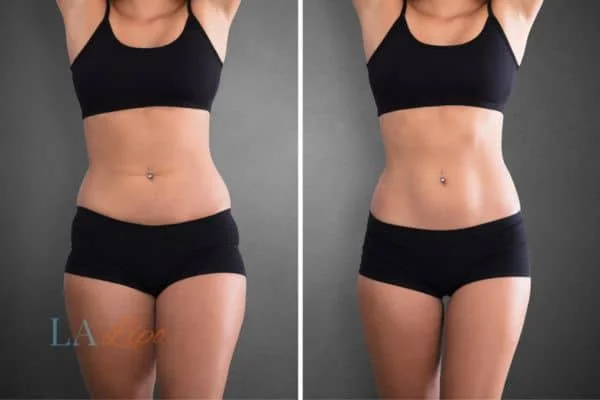 before and after results of non-surgical treatment to help a woman's body image and mental health Old Trafford