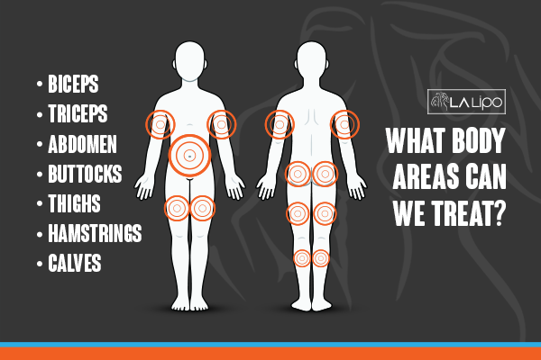 Diagram to show areas you can have LA-EMS Body Sculpting Treatment Old Trafford