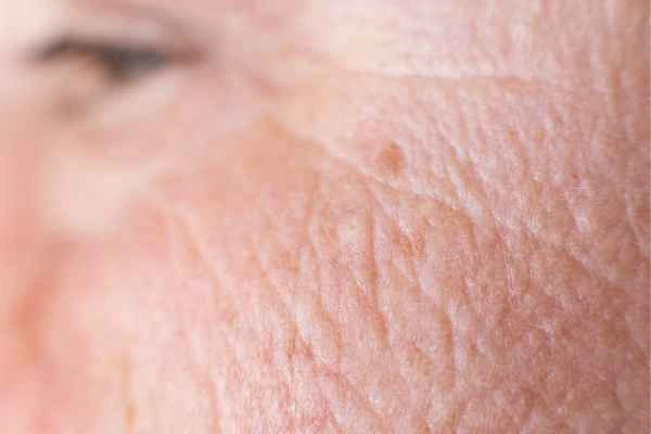 close up picture of a woman's face showing an age spot Old Trafford