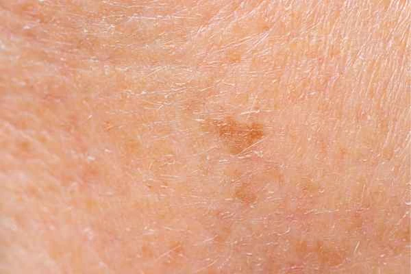 close up picture of age spots Old Trafford