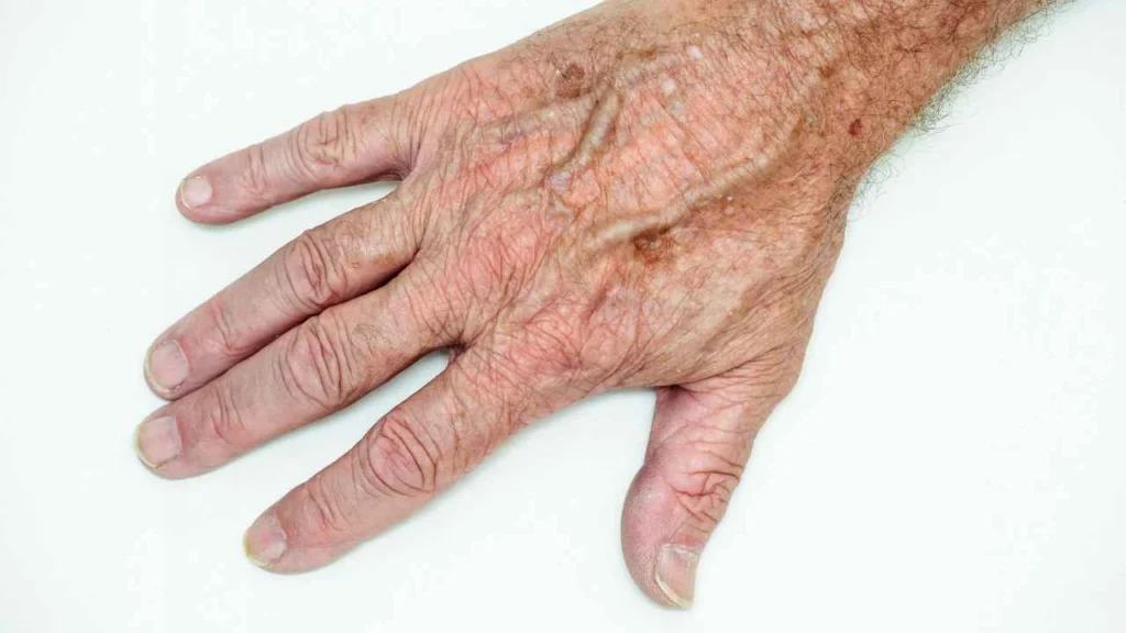 Male hand showing age spot Old Trafford