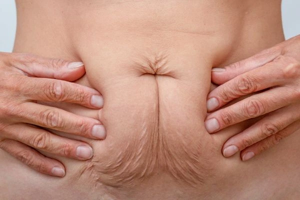 Image of a woman's stomach with loose skin - example of skin tightening Old Trafford options
