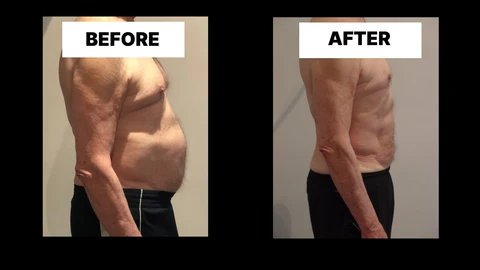 What Symptoms Can Diastasis Recti Cause in Men? Weak Core, Back Pain and Poor Posture Old Trafford